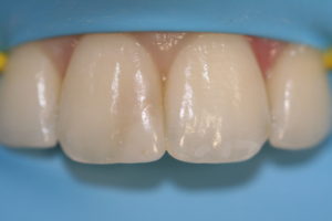 image of bioclear rubber dam isolation pre treatment