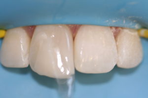 image of bioclear overfilled