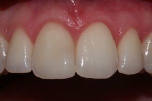 image of bioclear results