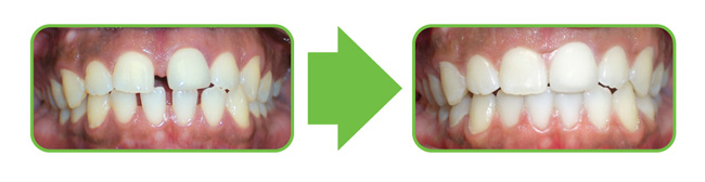 image of ClearCorrect before and after