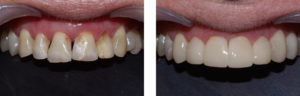 image of black triangle bioclear treated