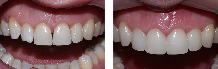 image of black triangle bioclear treated