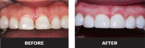 image of black triangle teeth before and after