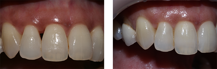 image of black triangle teeth before and after