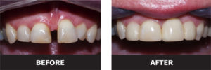image of filling gap between teeth