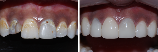 image of bioclear-dental-treatment