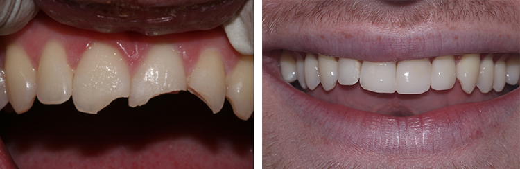 image of bioclear-treatment-for-broken-teeth