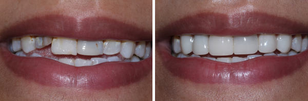 image of bioclear-treatment-for-uneven-teeth