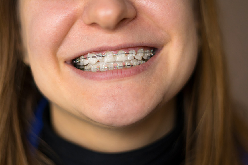 image of clear braces on teeth