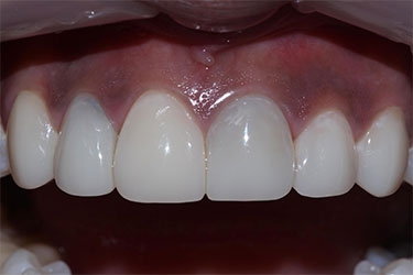 image of front teeth post bioclear composite bonding