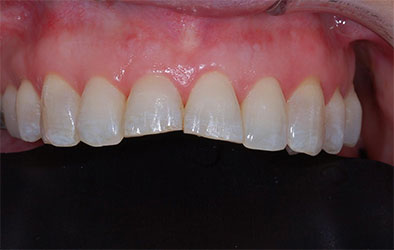 image of front teeth post orthodontics