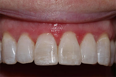 image of front teeth post traditional composite bonding