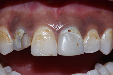 image of front teeth pre treatment