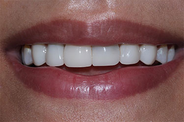 image of smile after bioclear composite bonding