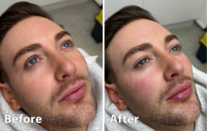 image of cheek enhancement treatment