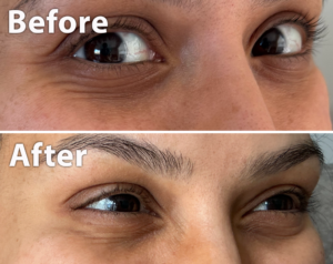 image of crow's feet treatment