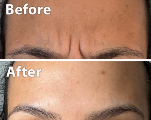 image of frown lines treatment