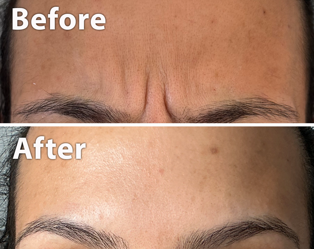 image of frown lines treatment