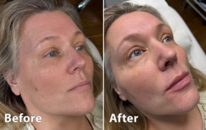 image of lip enhancement treatment