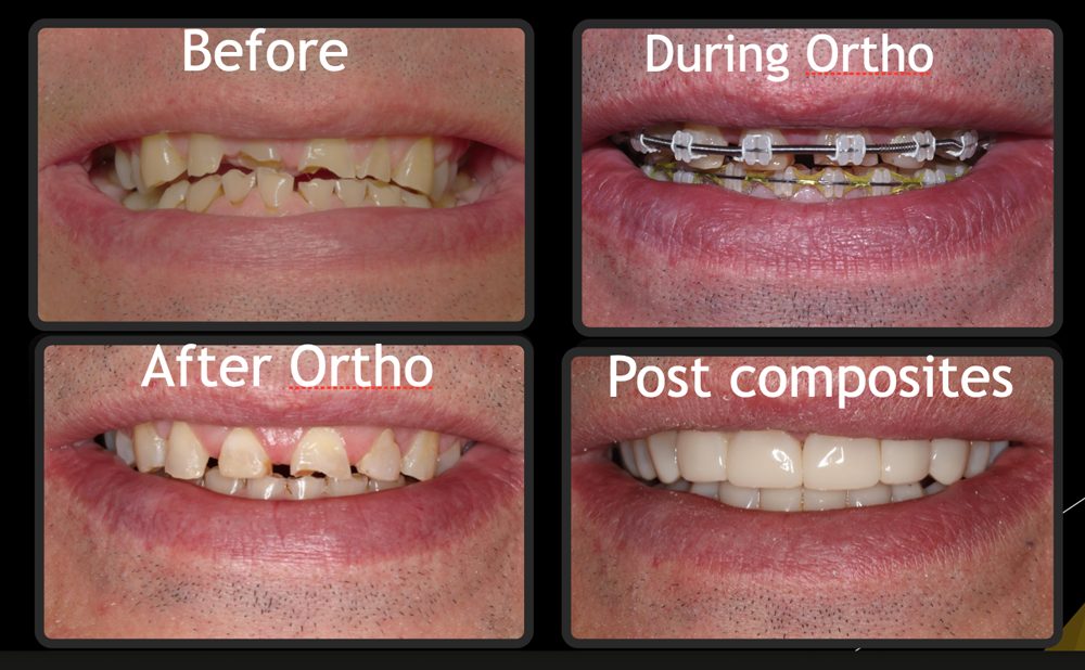 We have a number of ways of correcting your smile. image of mens teeth before after
